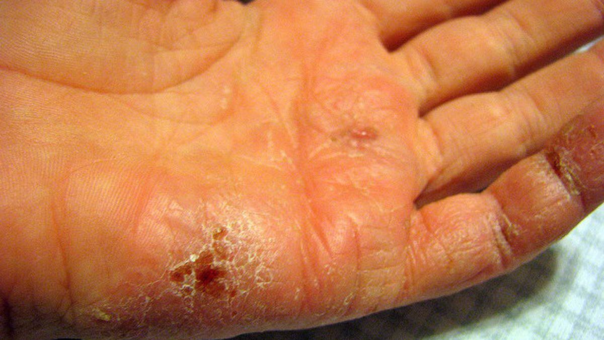 How To Prevent Dry Cracked Hands This Winter